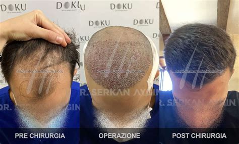 serkan aygin le iene|Trapianto capelli in Turchia .